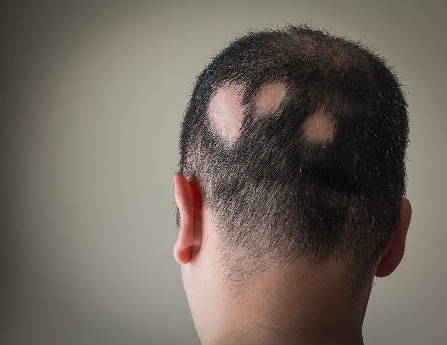 你知道鬼剃头的成因吗-分享斑秃的治疗方法