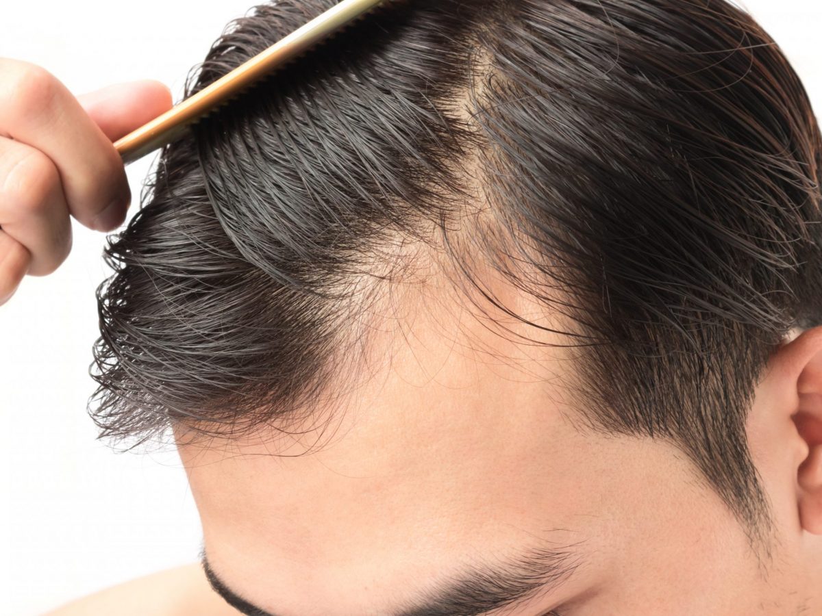 生髮藥物副作用多, 激光生髮療程治療脫髮更安全可靠| Beauty Place