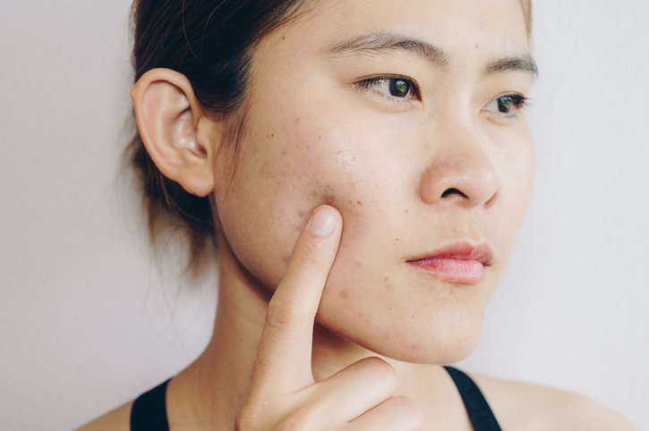 閉口粉刺怎麼消?90%人不知道的極速去粉刺方法| Beauty Place